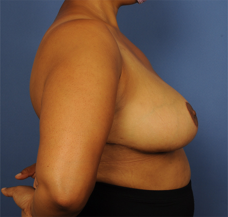 Breast Reduction Before & After Image