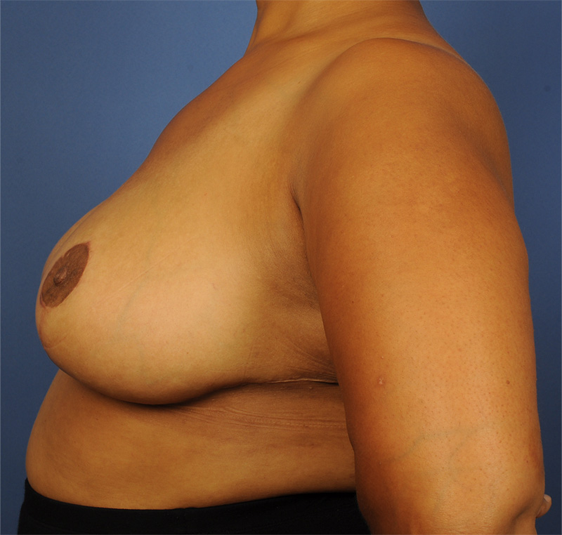 Breast Reduction Before & After Image