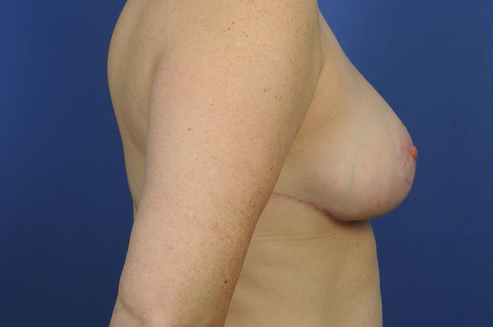 Breast Reduction Before & After Image