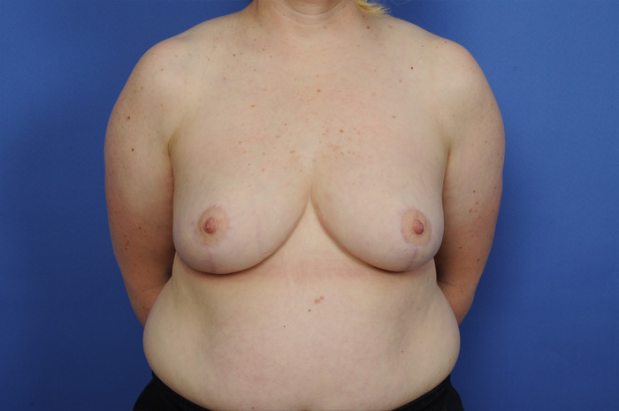 Breast Reduction Before & After Image