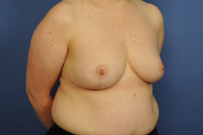 Breast Reduction Before & After Image