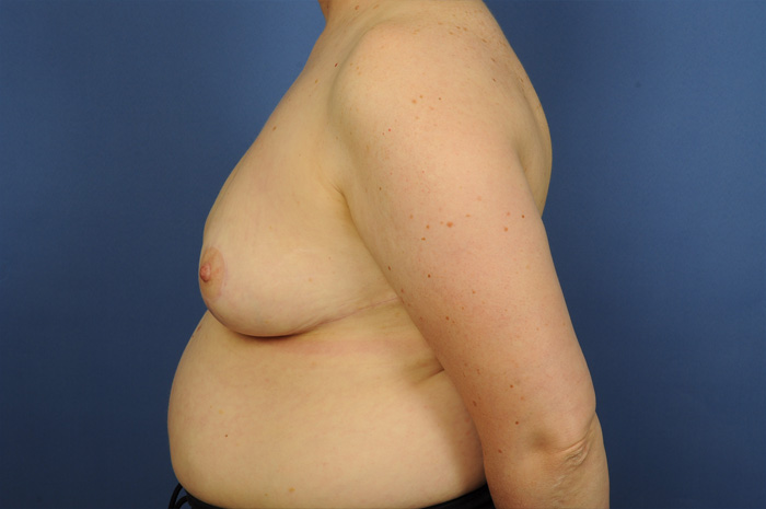 Breast Reduction Before & After Image