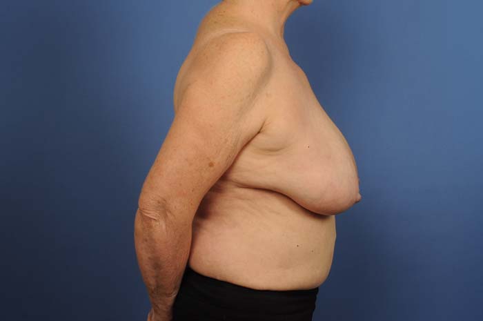 Breast Reduction Before & After Image