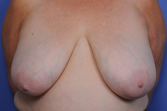 Breast Reduction Before & After Image