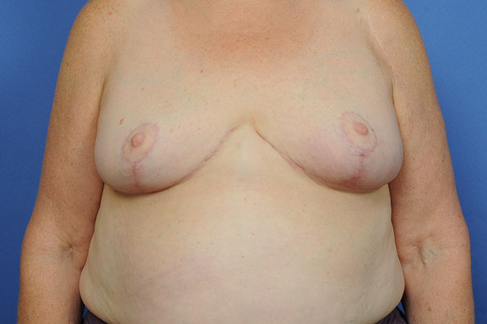 Breast Reduction Before & After Image