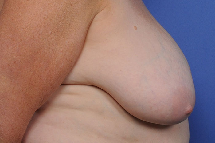 Breast Reduction Before & After Image