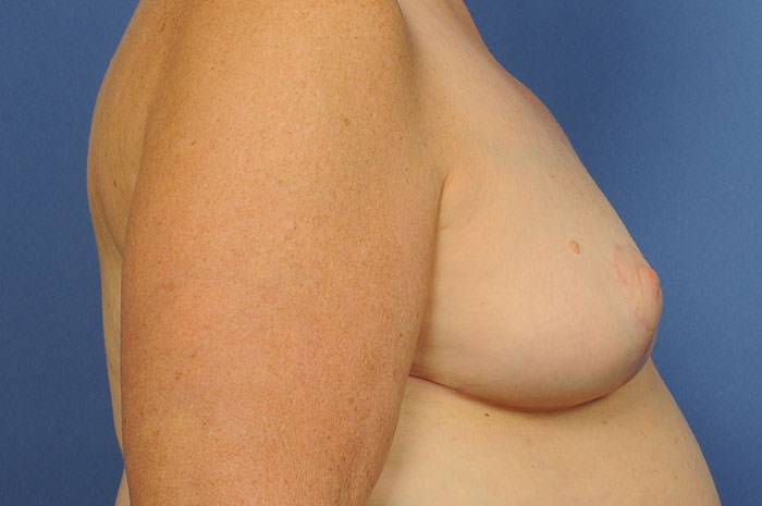 Breast Reduction Before & After Image