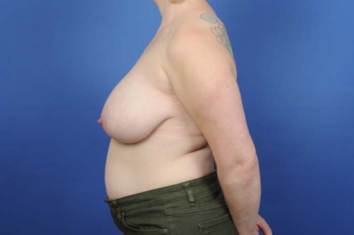 Breast Reduction Before & After Image