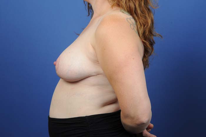 Breast Reduction Before & After Image