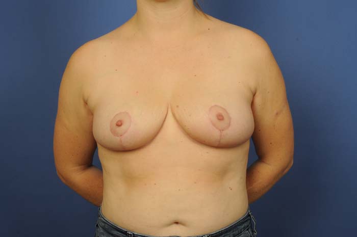 Breast Reduction Before & After Image