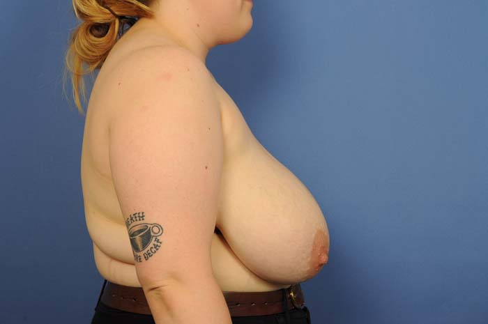 Breast Reduction Before & After Image