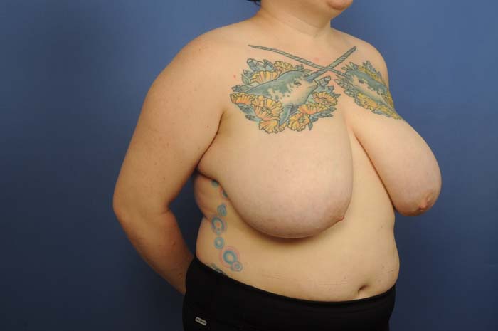 Breast Reduction Before & After Image