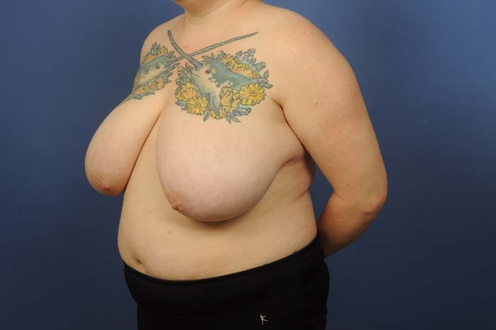 Breast Reduction Before & After Image