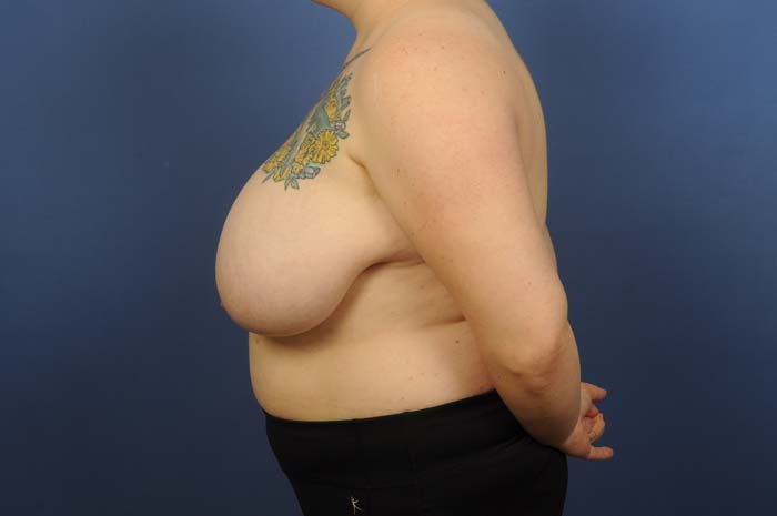 Breast Reduction Before & After Image