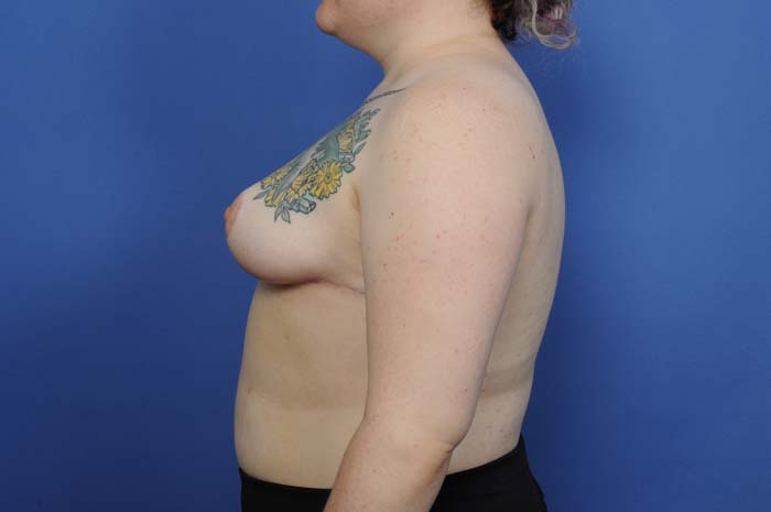 Breast Reduction Before & After Image