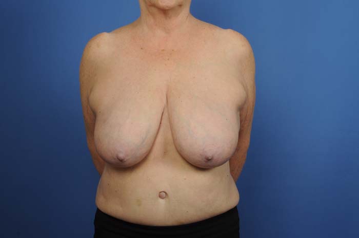 Breast Reduction Before & After Image