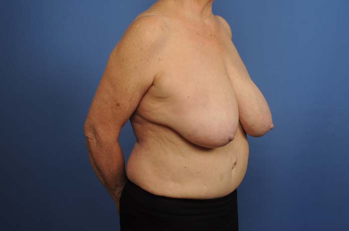 Breast Reduction Before & After Image