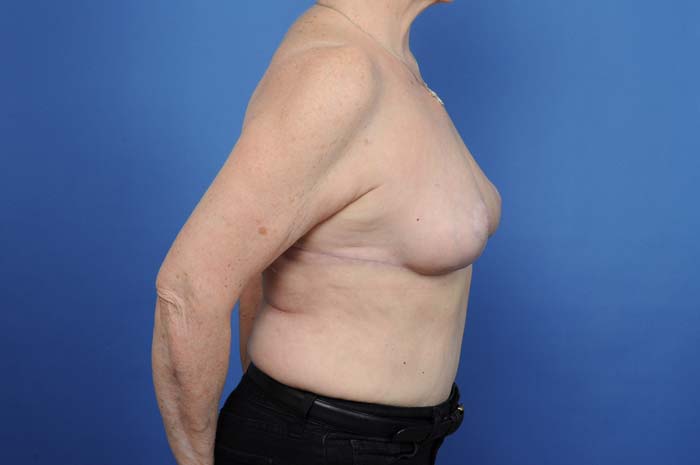 Breast Reduction Before & After Image