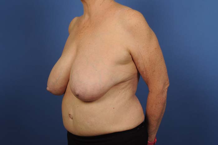 Breast Reduction Before & After Image