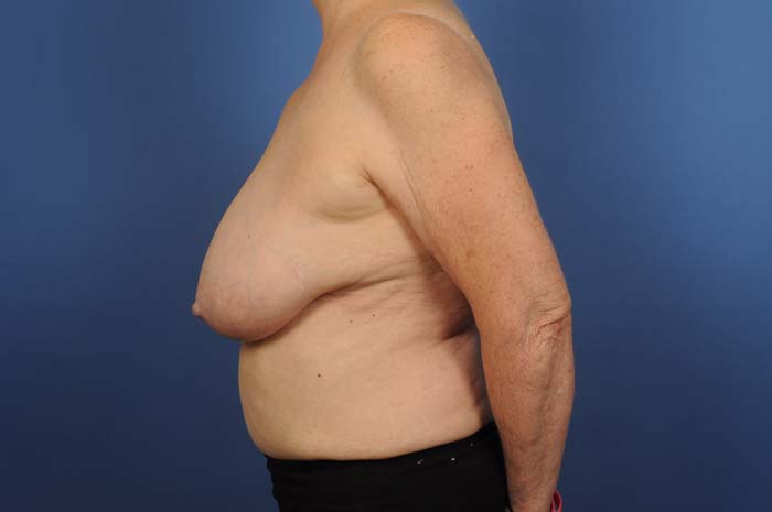 Breast Reduction Before & After Image