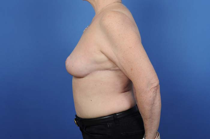 Breast Reduction Before & After Image