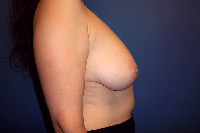 Breast Reduction Before & After Image