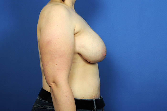 Breast Reduction Before & After Image