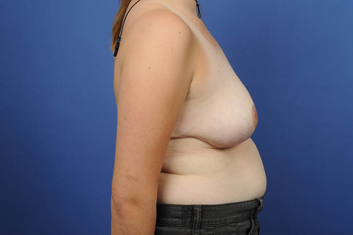 Breast Reduction Before & After Image