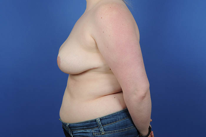 Breast Reduction Before & After Image