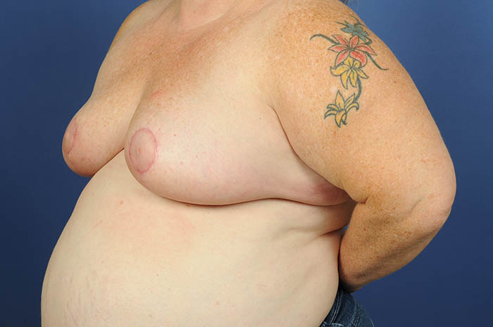 Breast Reduction Before & After Image