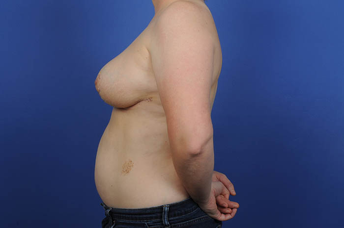 Breast Reduction Before & After Image