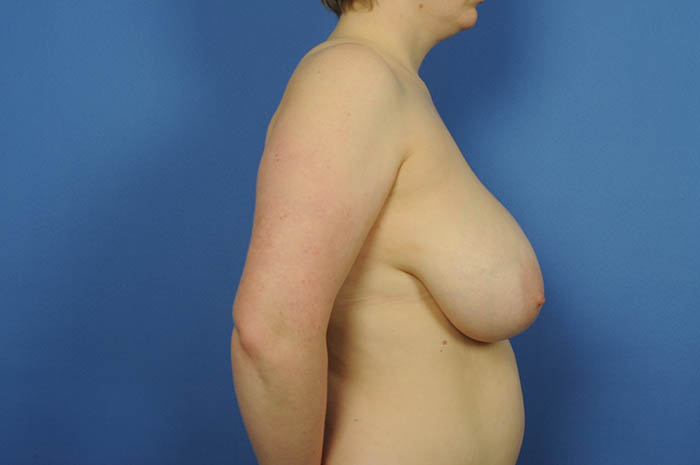 Breast Reduction Before & After Image