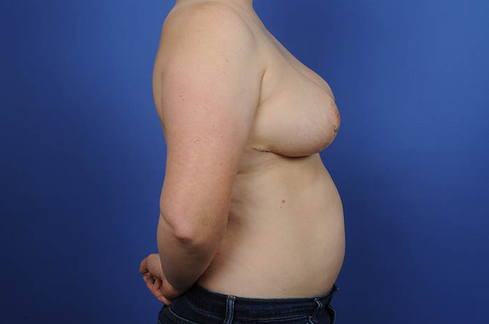 Breast Reduction Before & After Image