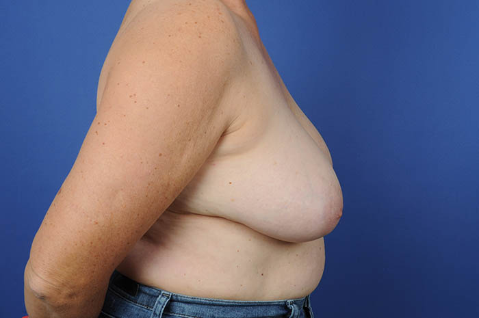 Breast Reduction Before & After Image