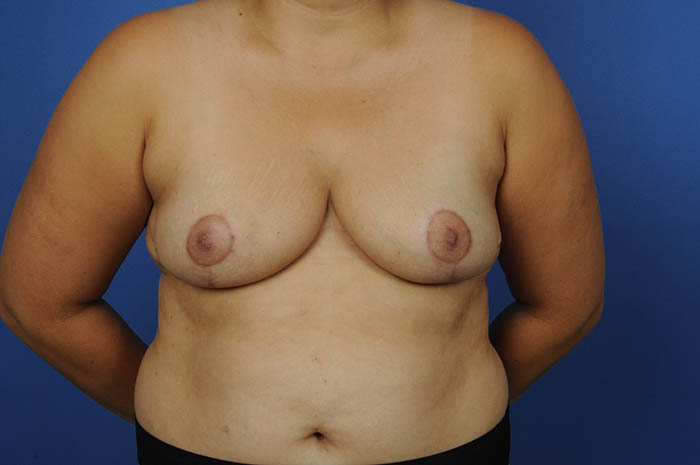 Breast Reduction Before & After Image