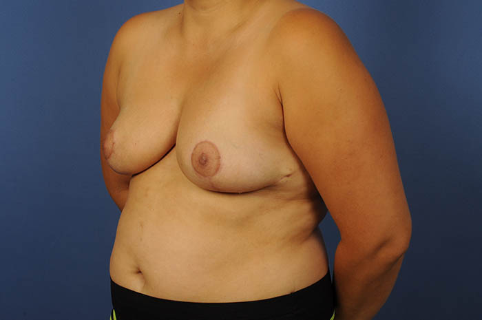 Breast Reduction Before & After Image