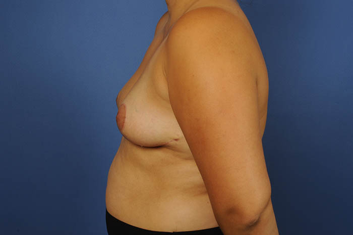 Breast Reduction Before & After Image