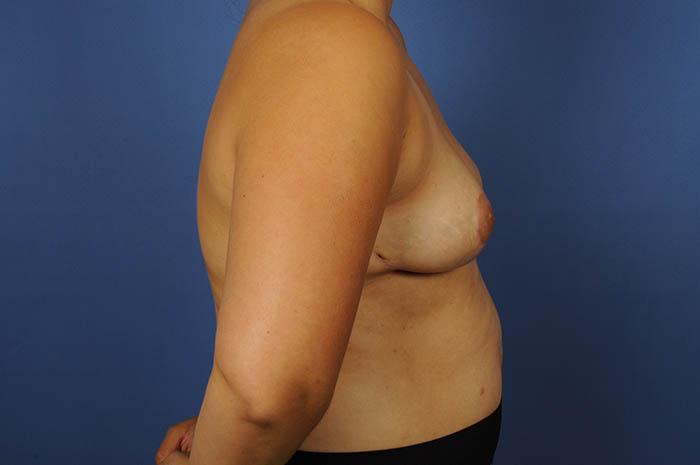 Breast Reduction Before & After Image