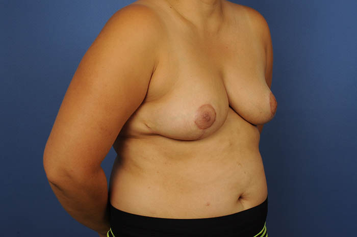 Breast Reduction Before & After Image