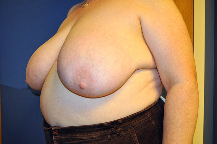 Breast Reduction Before & After Image