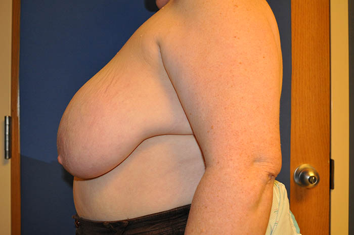 Breast Reduction Before & After Image