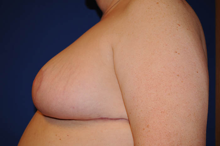 Breast Reduction Before & After Image