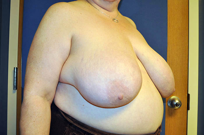 Breast Reduction Before & After Image