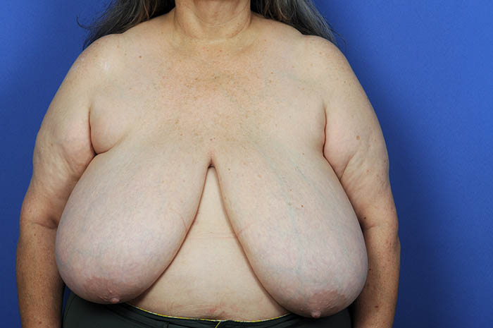 Breast Reduction Before & After Image