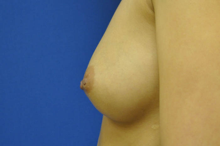 Inverted Nipple Repair Before & After Image