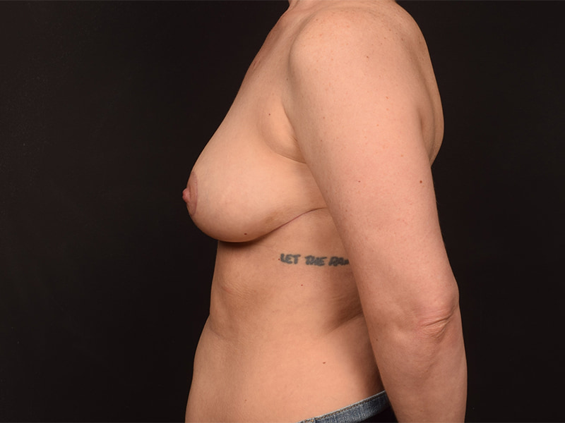 Lumpectomy Before & After Image