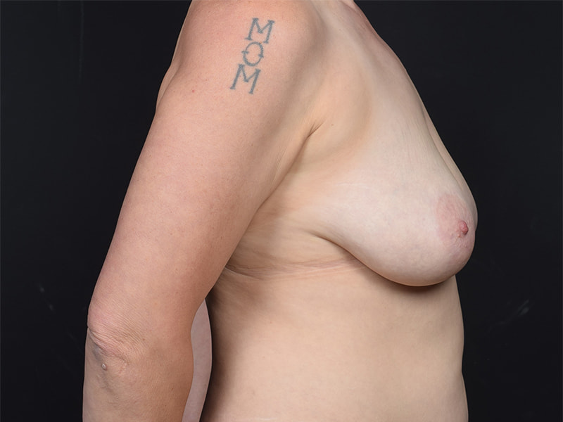 Lumpectomy Before & After Image