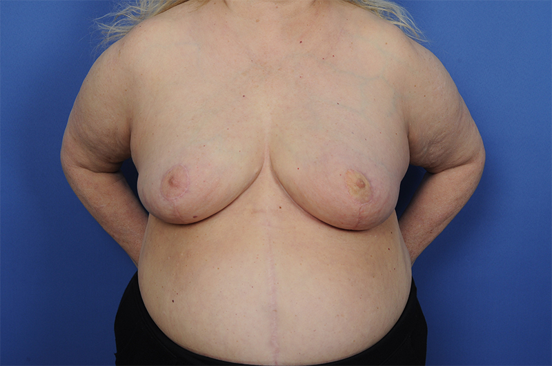 Lumpectomy Before & After Image