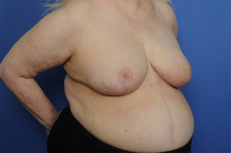 Lumpectomy Before & After Image