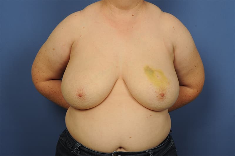 Lumpectomy Before & After Image